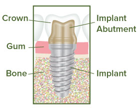 Dental Implant Illustration - Team Dental of Joplin